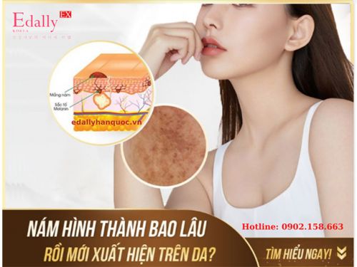 Nám Da Hình Thành Bao Lâu Rồi Mới Xuất Hiện?