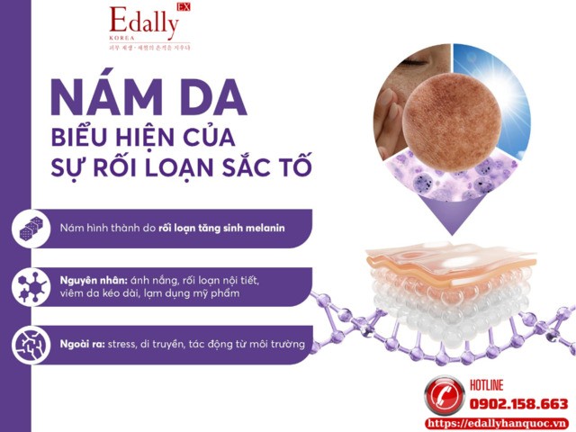 Nám da là biểu hiện của sự rối loạn sắc tố