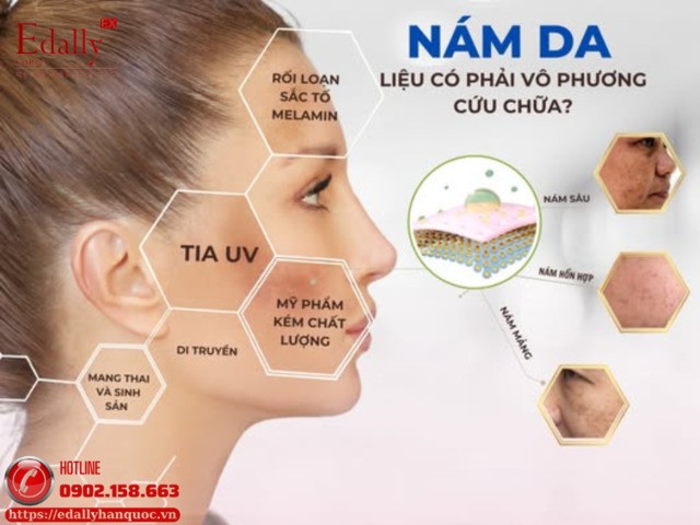 Nám da kháng trị có phải là vô phương cứu chữa?