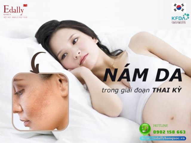 Nám da thai kỳ (Chloasma) và những điều mẹ bầu nên biết để điều trị dứt điểm