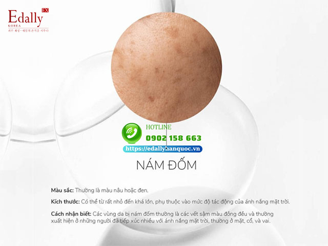 Nám đốm là gì?