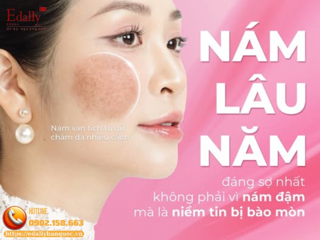 Nám lâu năm đáng sợ nhất không phải vì nám đậm mà là niềm tin bị bào mòn
