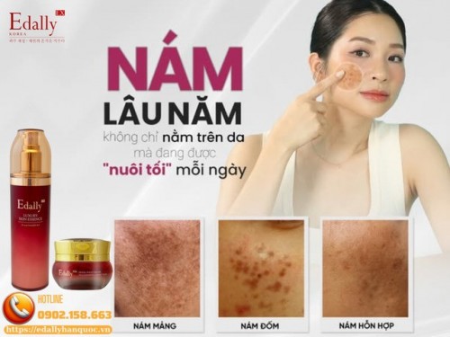 Nám Lâu Năm Tại Sao Lại Khó Chữa Và Chữa Sao Cho Đúng?