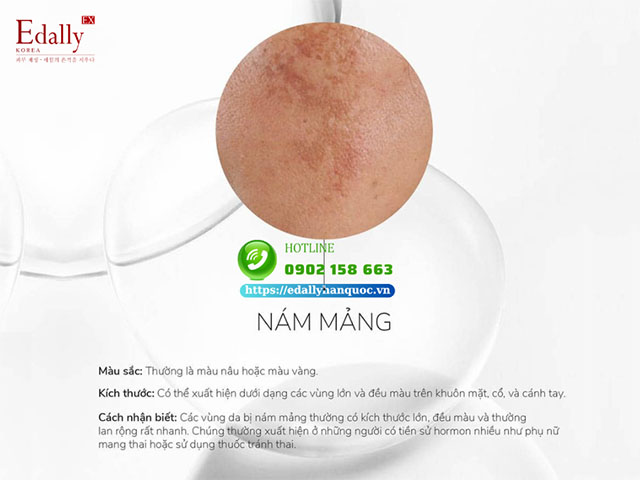 Nám mảng là gì?