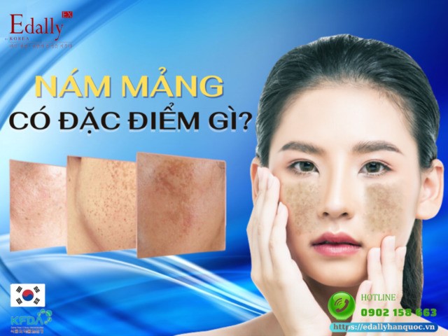 Nám mảng có đặc điểm gì?