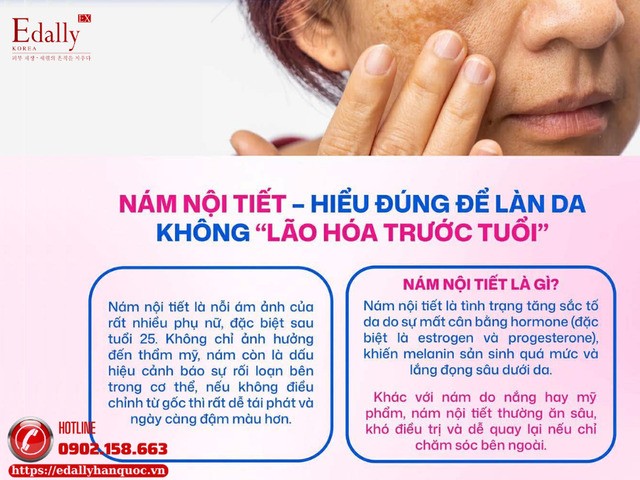 Nám nội tiết - hiểu đúng để làn da không lão hóa trước tuổi