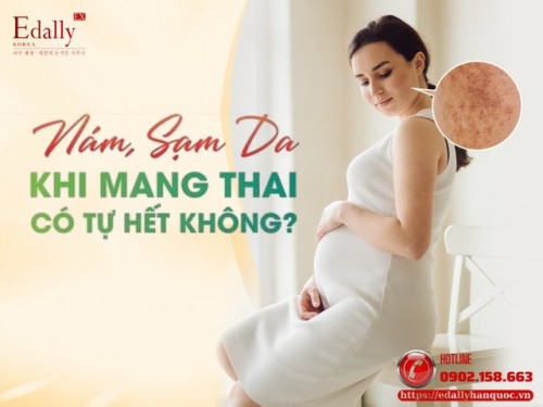 Nám, Sạm Da Khi Mang Thai Có Tự Hết Không?