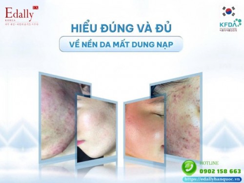 Nền Da Mất Dung Nạp Và Cách Chăm Sóc Hiệu Quả