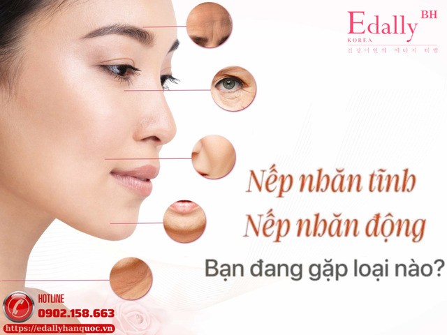 Nếp nhăn động và nếp nhăn tĩnh - Bạn đang gặp loại nào?