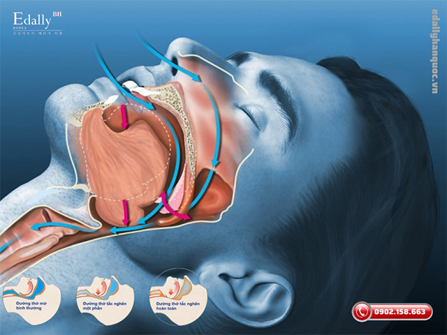 Hội chứng ngưng thở khi ngủ - Nguyên nhân, triệu chứng và cách điều trị hiệu quả