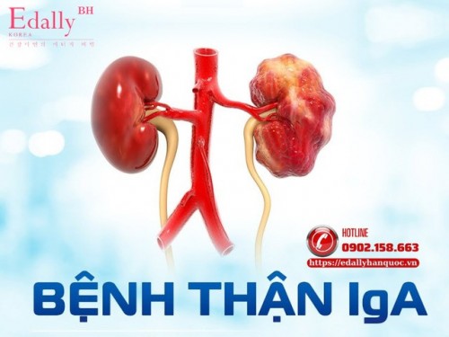 Người Bệnh Thận IgA Giữ Được Bao Nhiêu Lâu Thì Phải Ghép Hay Chạy Thận Nhân Tạo?