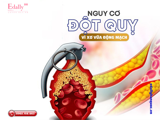 Nguy cơ đột quỵ não vì xơ vữa động mạch