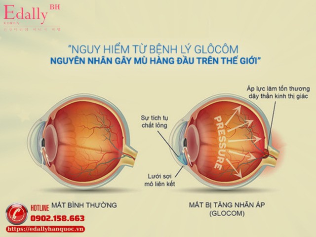 Nguy hiểm từ bệnh lý Glôcôm - Nguyên nhân gây mù hàng đầu thế giới