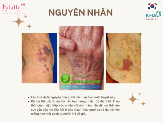 Những nguyên nhân gây nên tình trạng ban xuất huyết ở người già