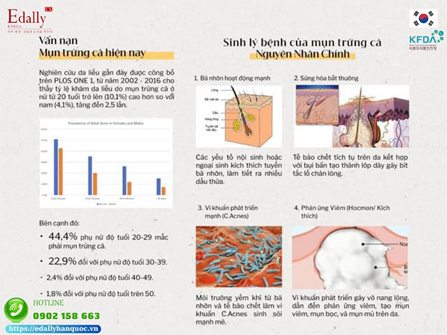 Nguyên nhân chính gây mụn trứng cá trên nền da yếu