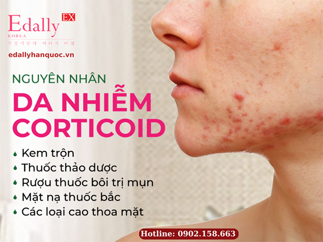 Làm thế nào để nhận biết da mặt bị nhiễm độc tố Corticoid?