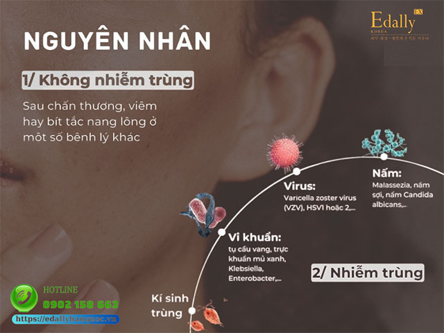 Những nguyên nhân gây ra bệnh viêm nang lông