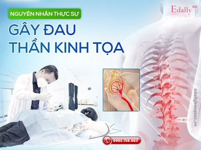 Nguyên nhân thực sự gây đau dây thần kinh tọa là gì?