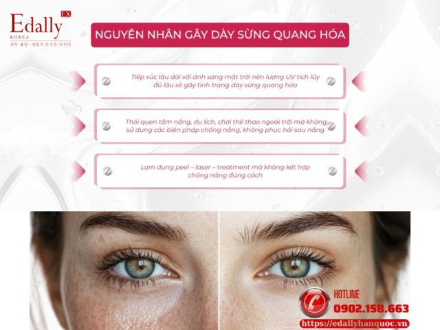 Nguyên nhân khiến da bị dày sừng quang hóa là gì?
