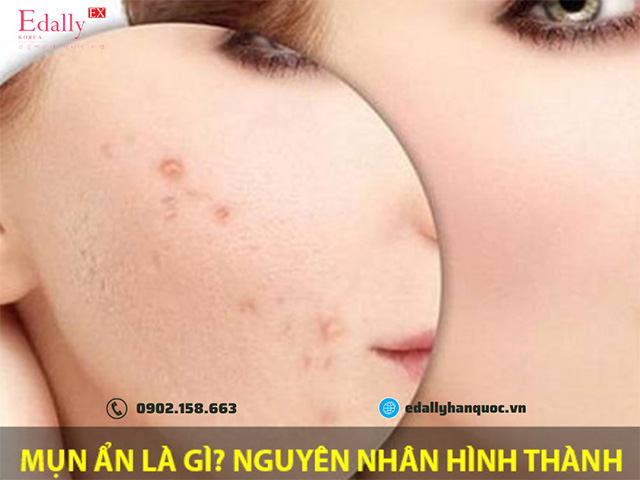 Nguyên nhân gây mụn ẩn dưới da