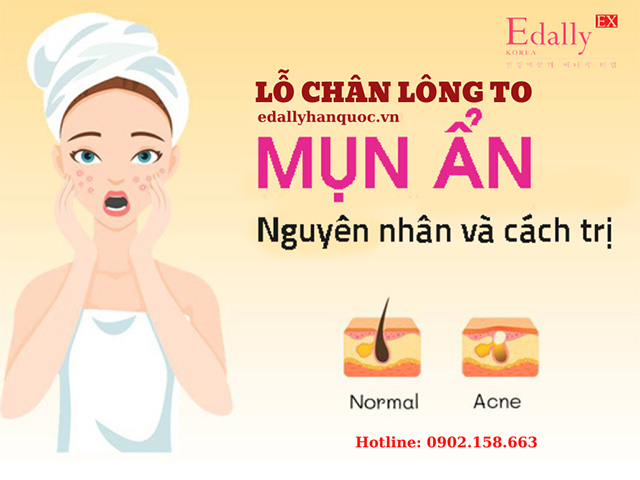 Cách Trị Mụn Ẩn Và Lỗ Chân Lông To