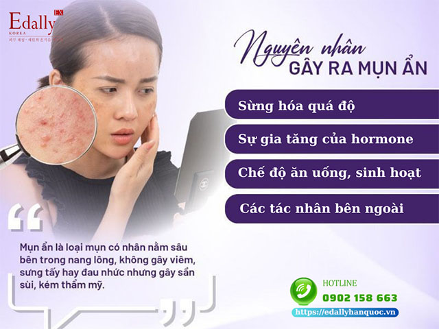 Những nguyên nhân gây mụn ẩn dưới da