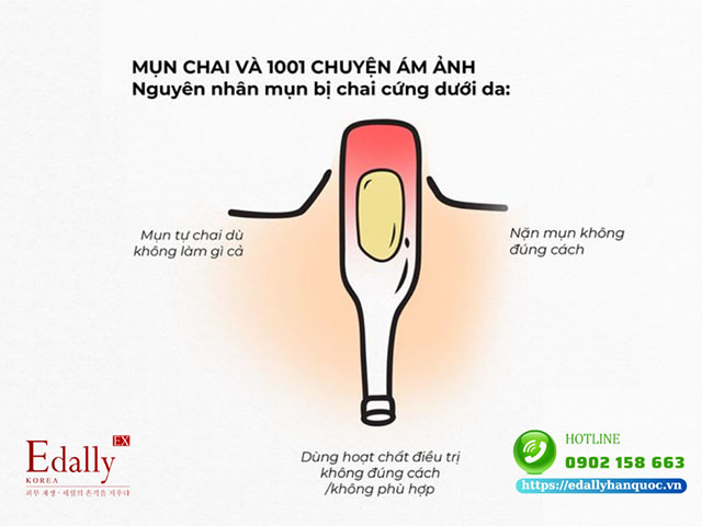 Nguyên nhân gây mụn chai viêm dưới da