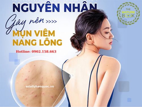 Bị Mụn Lưng, Viêm Nang Lông Phải Làm Sao?