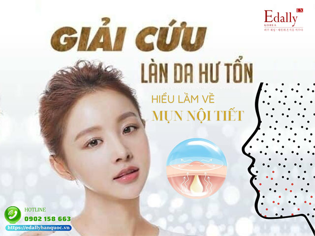 Mụn nội tiết và những hiểu lầm thường hay gặp