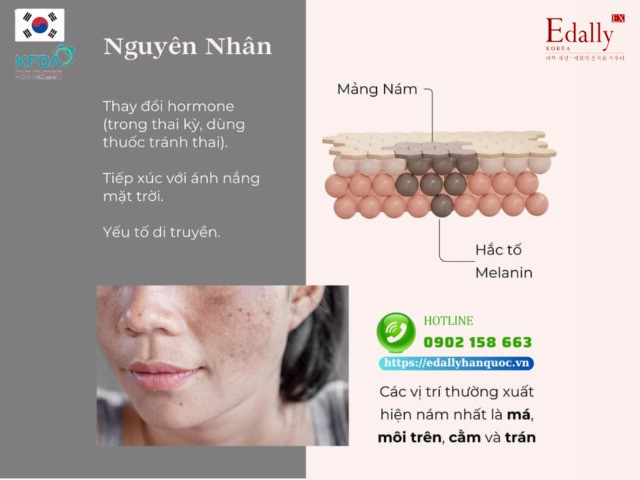 Nguyên nhân gây nám da thai kỳ (Chloasma) là gì?