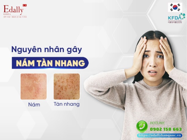 Nguyên nhân gây nám da và tàn nhang ở người và cách phòng ngừa hiệu quả