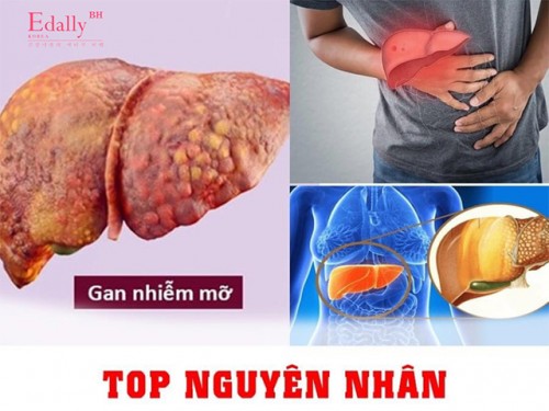 Gan Nhiễm Mỡ - Nguyên Nhân Do Đâu?