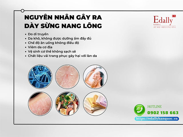 Tại sao lại bị dày sừng nang lông?