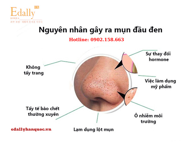 Nguyên nhân gây ra mụn đầu đen là gì?