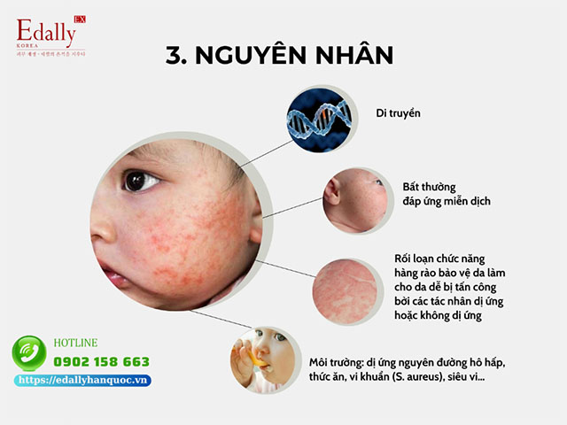 Những nguyên nhân gây bệnh Viêm da cơ địa