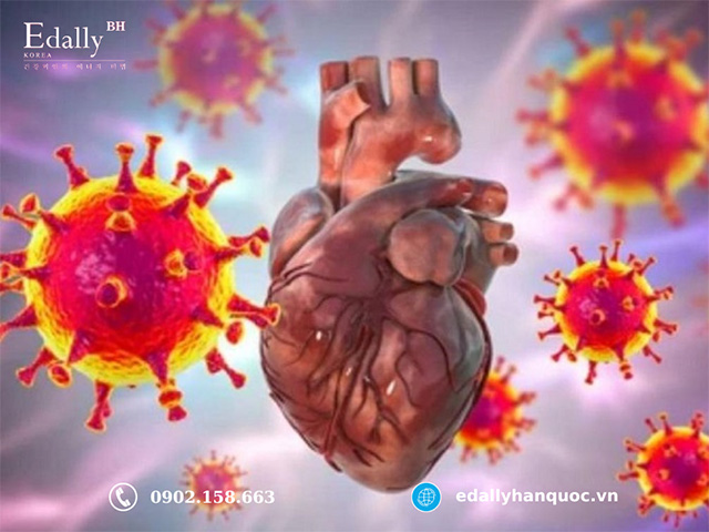 Nguyên nhân gây bệnh viêm cơ tim chủ yếu là do virus và vi khuẩn