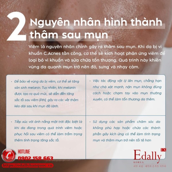 Nguyên nhân nào dẫn đến hình thành thâm sau mụn?