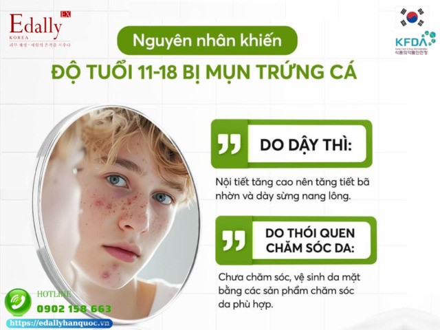 Nguyên nhân khiến người trẻ tuổi từ 11 đến 18 bị mụn trứng cá