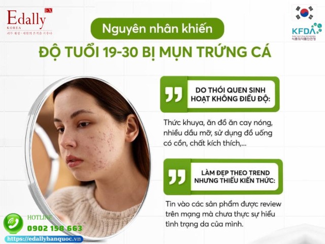 Nguyên nhân khiến người trẻ tuổi từ 19 đến 30 bị mụn trứng cá