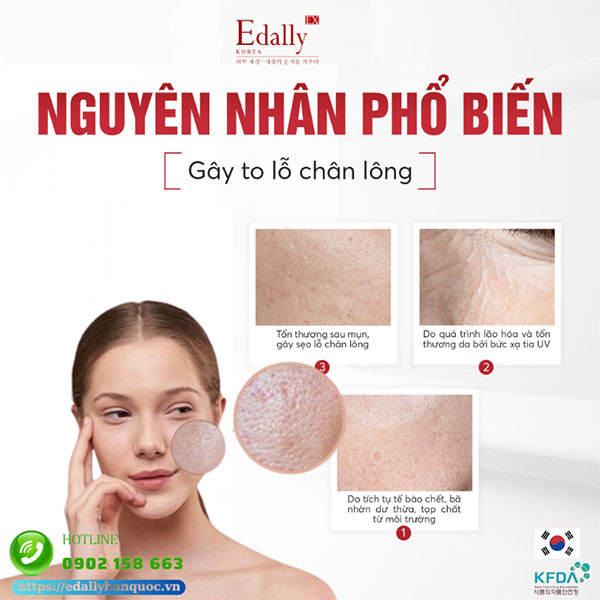 Nguyên nhân phổ biến gây to lỗ chân lông ở mặt