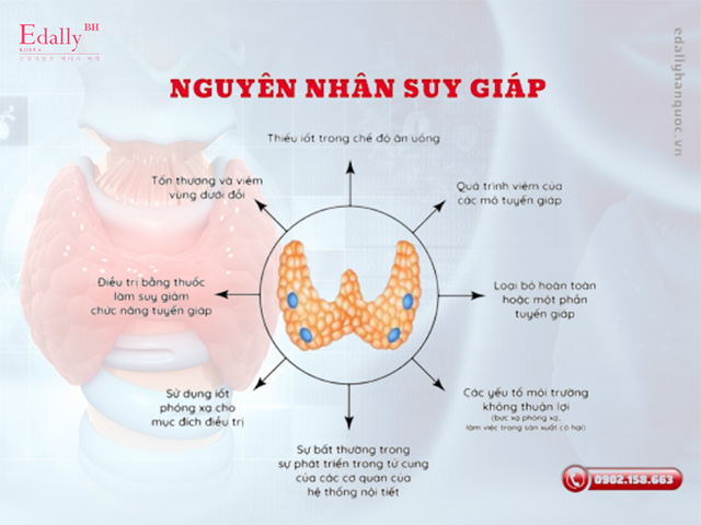 Nguyên nhân gây bệnh suy tuyến giáp