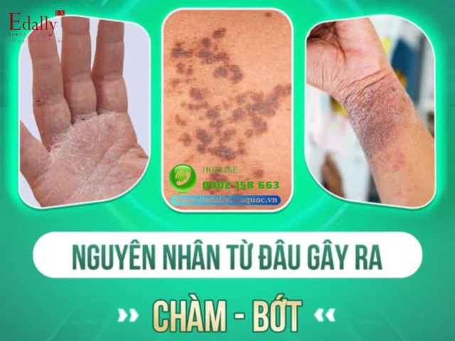 Nguyên nhân do đâu gây bệnh chàm bớt?