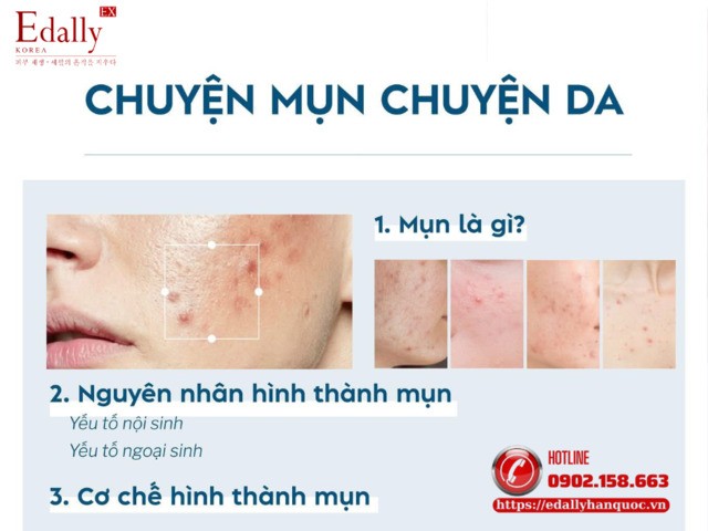 Nguyên Nhân & Cơ Chế Hình Thành Mụn