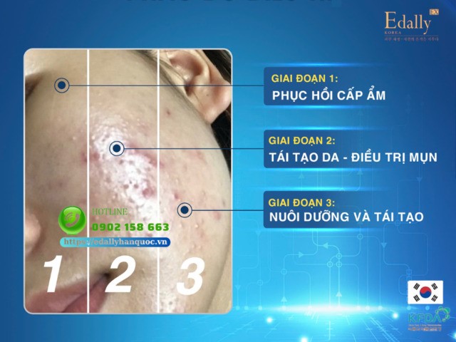 Cách điều nền da mất dung nạp hiệu quả tại nhà