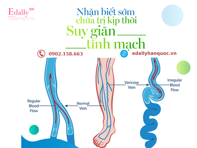 Nhận biết sớm các dấu hiệu của bệnh suy giãn tĩnh mạch để chữa trị kịp thời