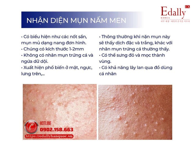 Dấu hiệu nhận diện Fungal acne - Da nhiễm nấm men, viêm da tiết bã, viêm nang lông