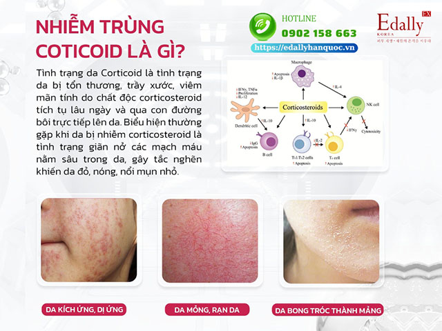 Viêm da do sử dụng mỹ phẩm chứa corticoid - Hiểu để điều trị hiệu quả