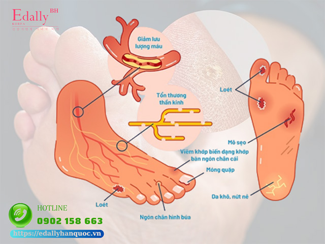 Nhiễm trùng da là biến chứng thường gặp khi mắc bệnh tiểu đường