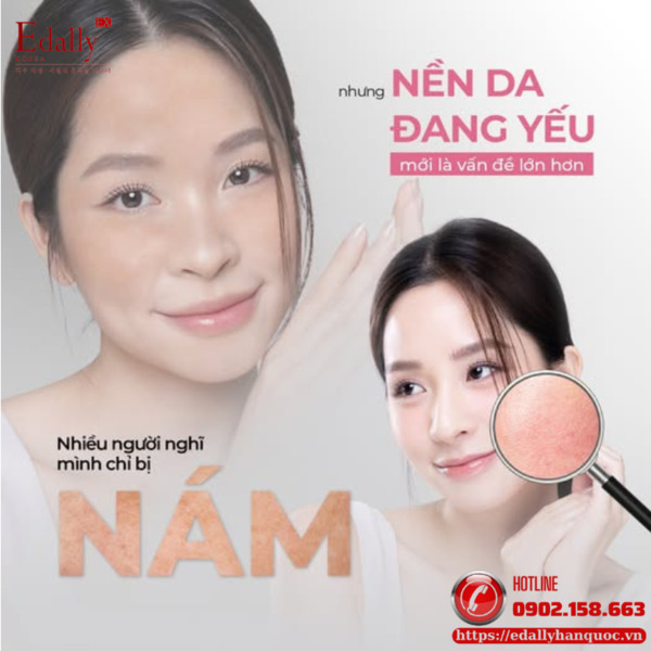 Sai lầm khi xử lý nám trên nền da yếu là dễ tin rằng phải dùng sản phẩm mạnh hơn mới có kết quả