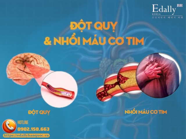 Đau tim (nhồi máu cơ tim) và đột quỵ não - Cuộc rượt đuổi của thời gian và sinh mạng